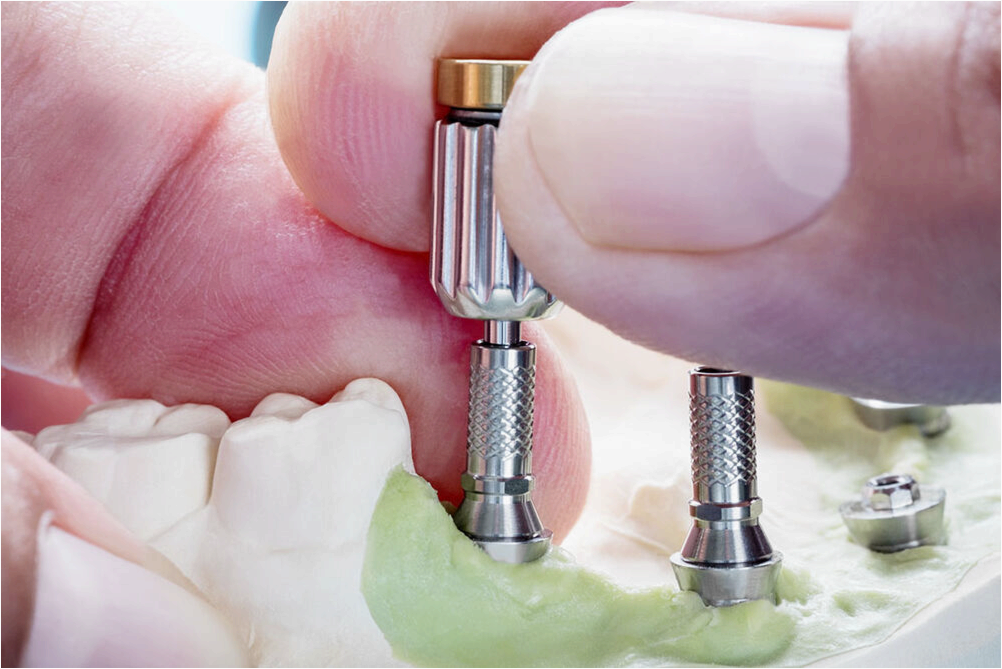 (плюсы, минусы, съемных, протезов) Pros and cons of removable dentures